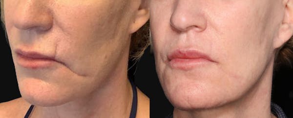 UltraClear® Before & After Gallery - Patient 564014 - Image 1