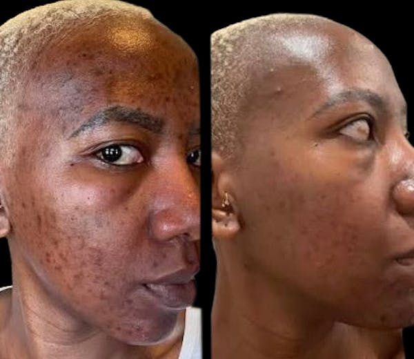 UltraClear® Before & After Gallery - Patient 371585 - Image 1
