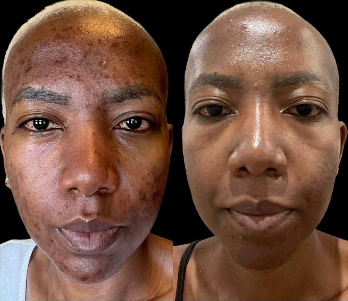 UltraClear® Before & After Gallery - Patient 371585 - Image 2