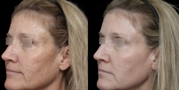 UltraClear® Before & After Gallery - Patient 232429 - Image 1