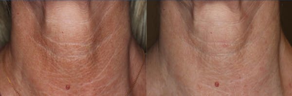 UltraClear® Before & After Gallery - Patient 563137 - Image 1