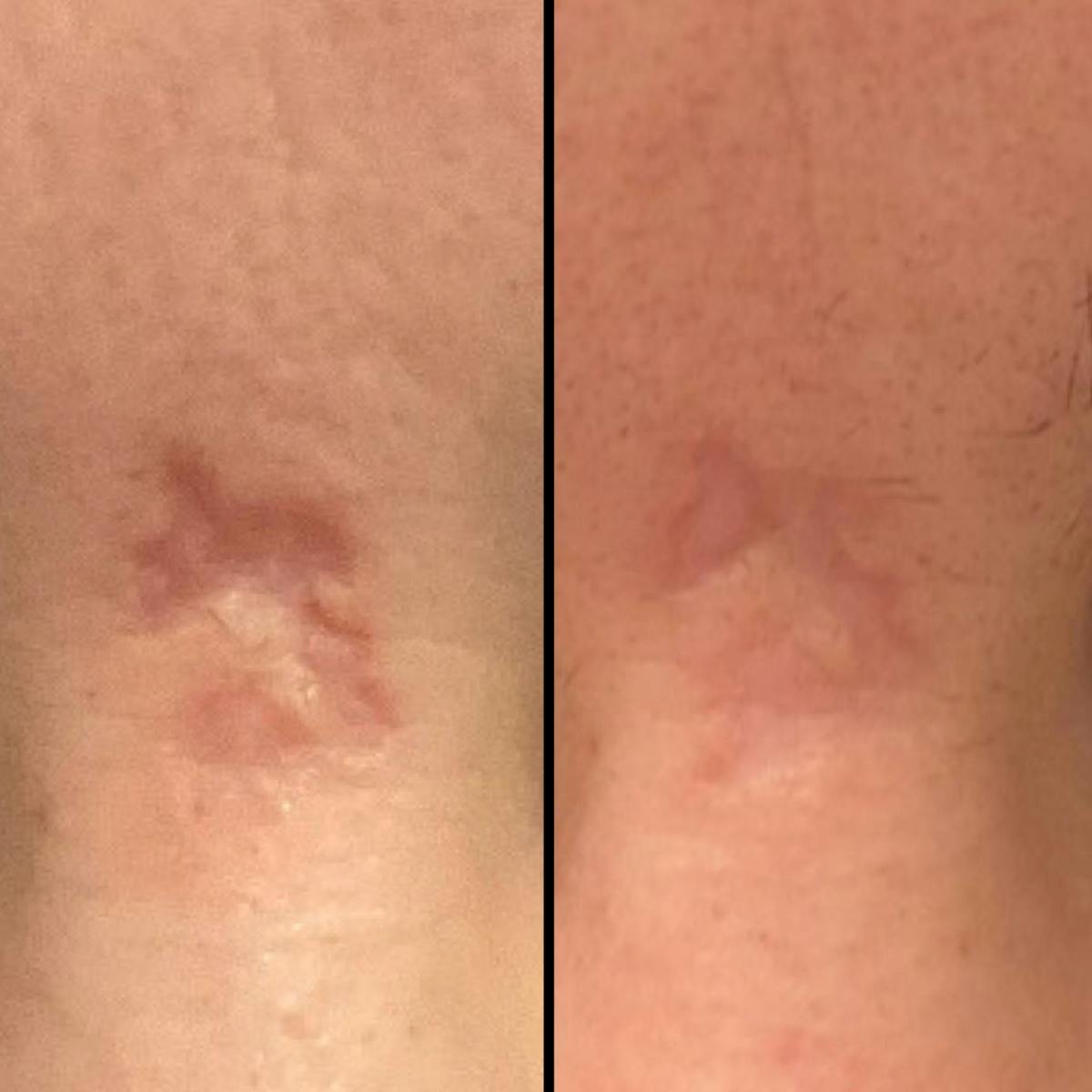 UltraClear® Before & After Gallery - Patient 321817 - Image 2