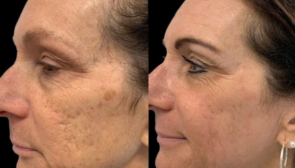 UltraClear® Before & After Gallery - Patient 205413 - Image 1