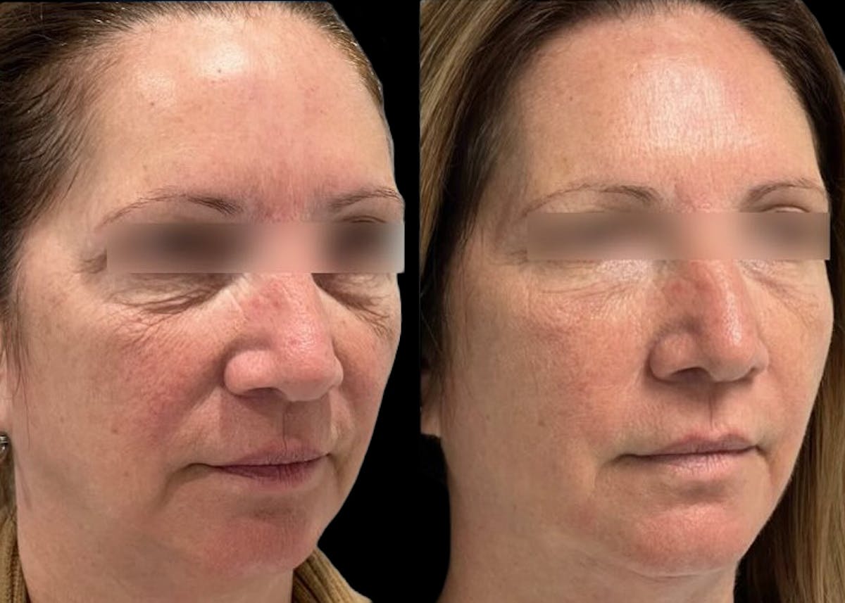 UltraClear® Before & After Gallery - Patient 203290 - Image 1