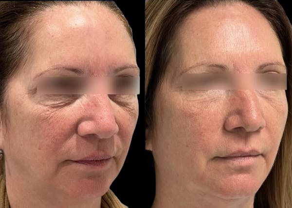 UltraClear® Before & After Gallery - Patient 203290 - Image 1