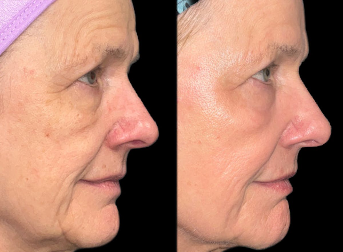 UltraClear® Before & After Gallery - Patient 151008 - Image 1