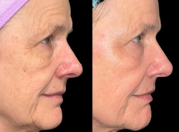 UltraClear® Before & After Gallery - Patient 151008 - Image 1
