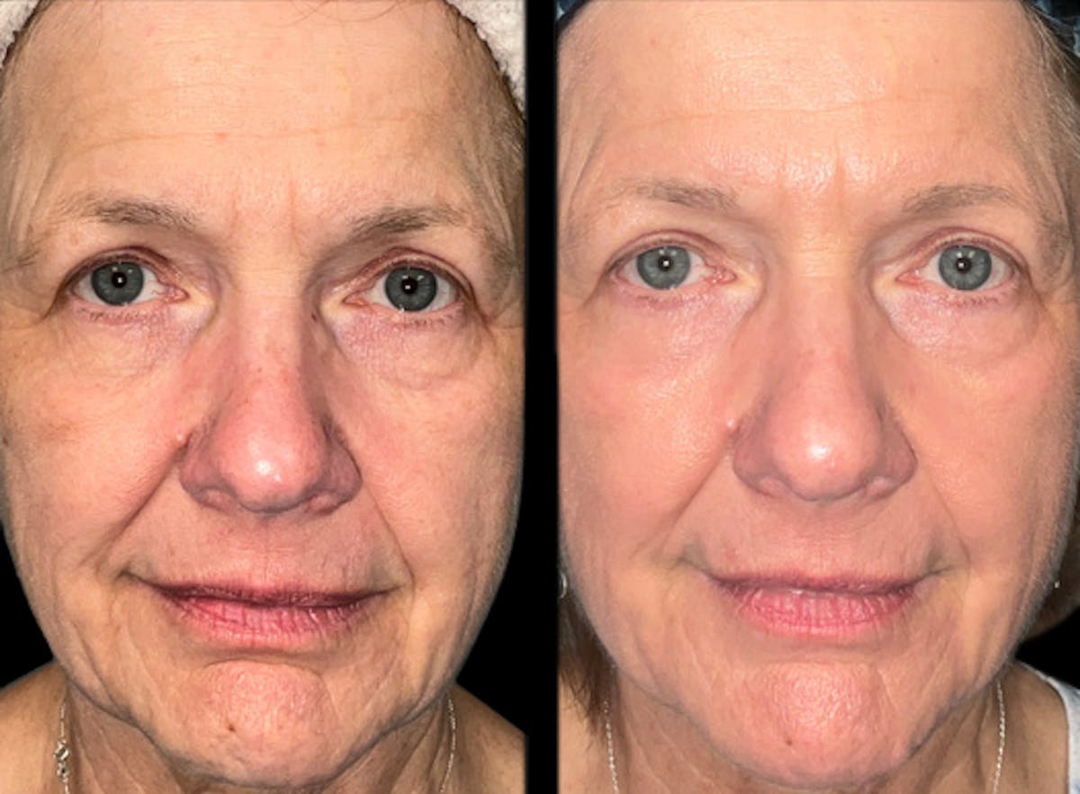 UltraClear® Before & After Gallery - Patient 151008 - Image 2