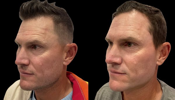 VivaMd Before & After Gallery - Patient 242555 - Image 1