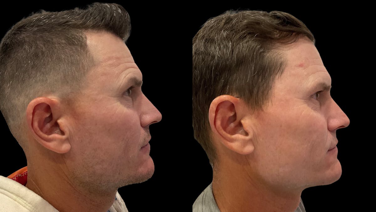 VivaMd Before & After Gallery - Patient 242555 - Image 2