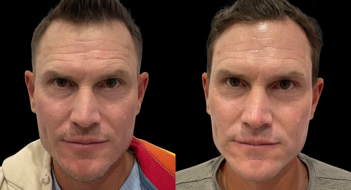 VivaMd Before & After Gallery - Patient 242555 - Image 3