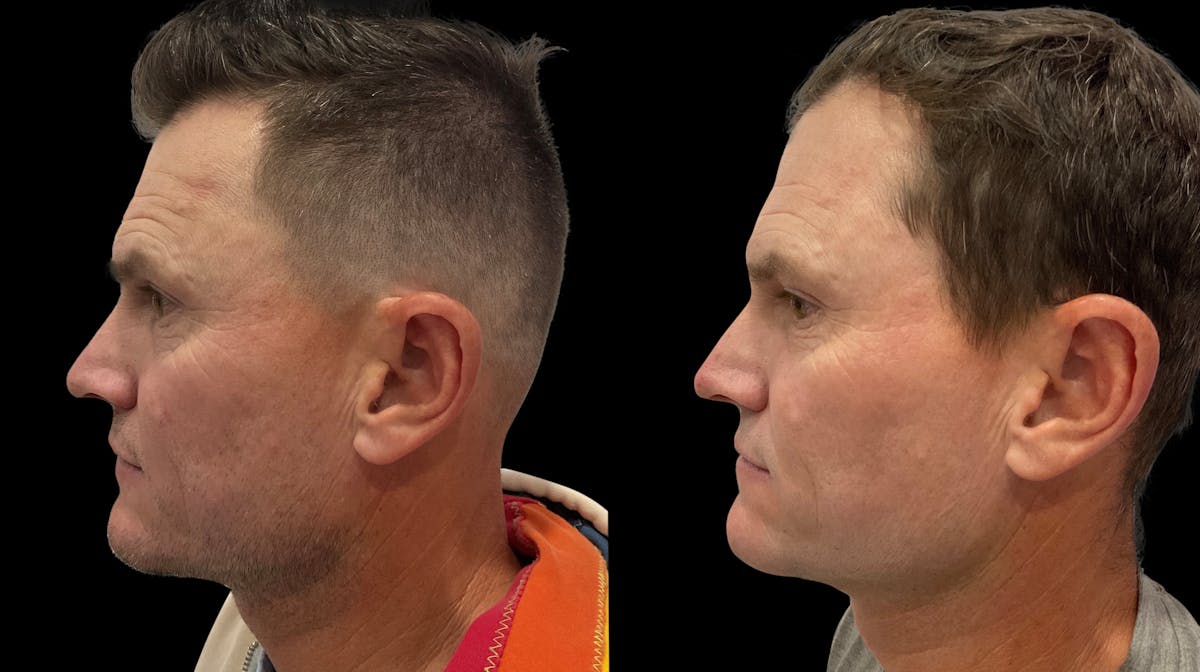 VivaMd Before & After Gallery - Patient 242555 - Image 4