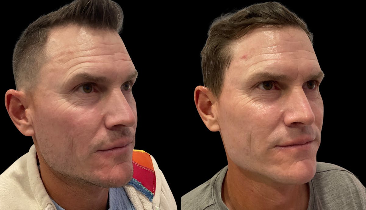 VivaMd Before & After Gallery - Patient 242555 - Image 5