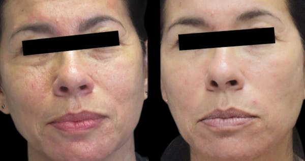 VivaMd Before & After Gallery - Patient 983801 - Image 1