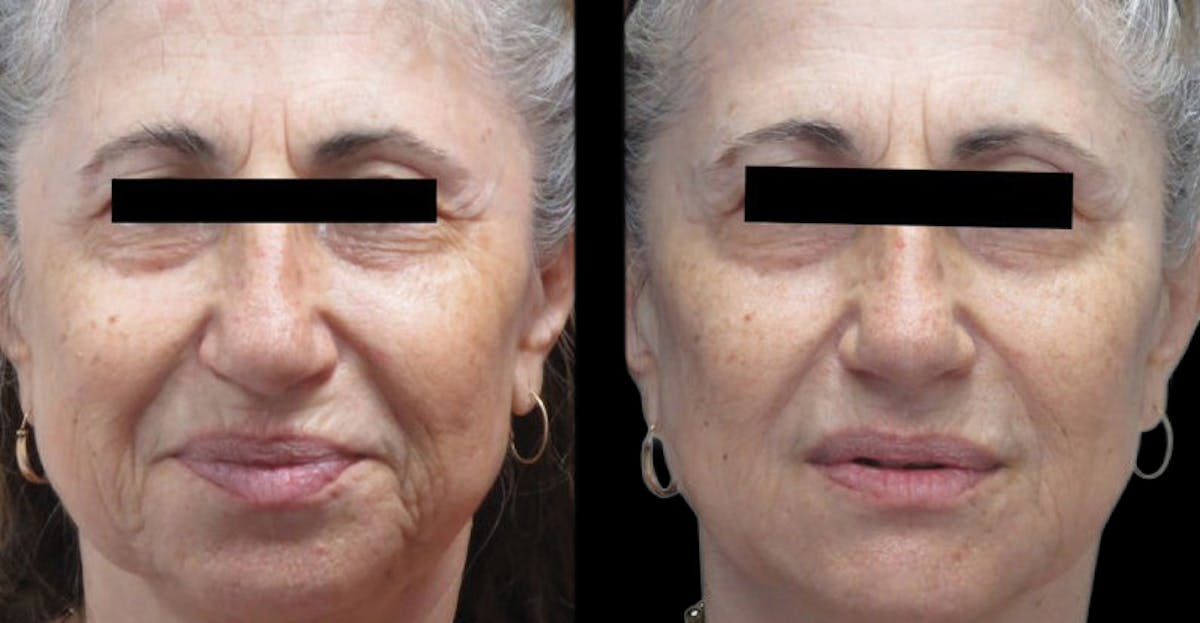 VivaMd Before & After Gallery - Patient 287627 - Image 1