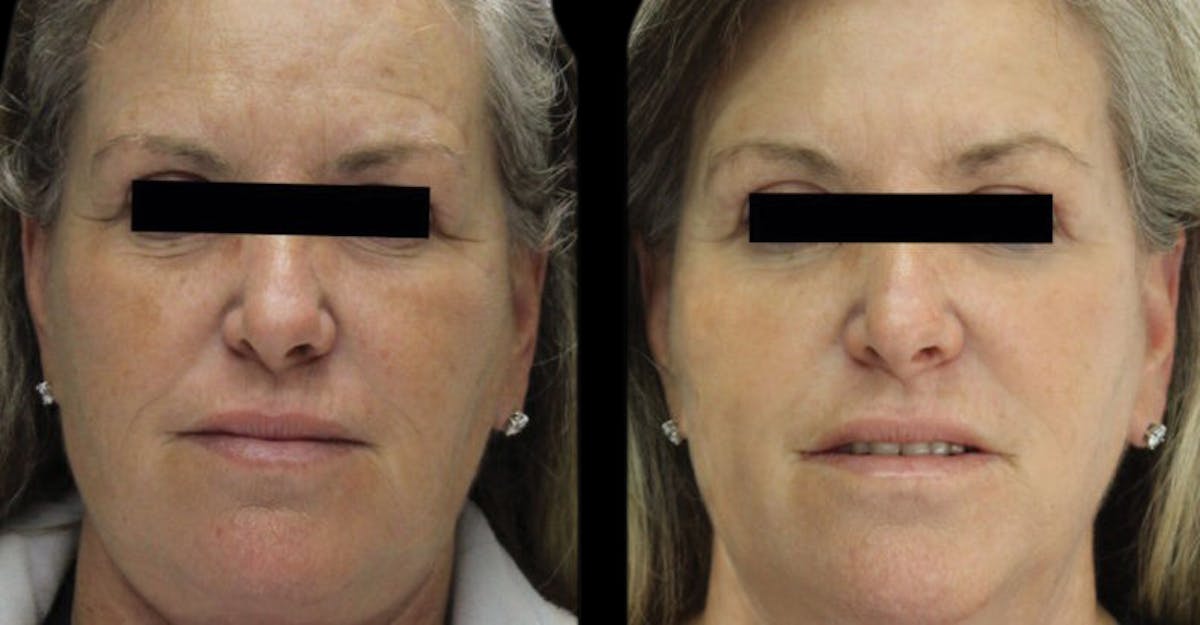 VivaMd Before & After Gallery - Patient 411712 - Image 1