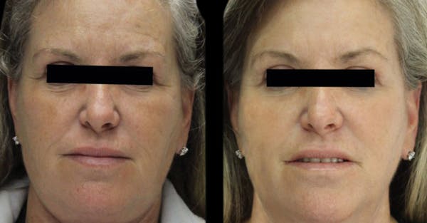 VivaMd Before & After Gallery - Patient 411712 - Image 1