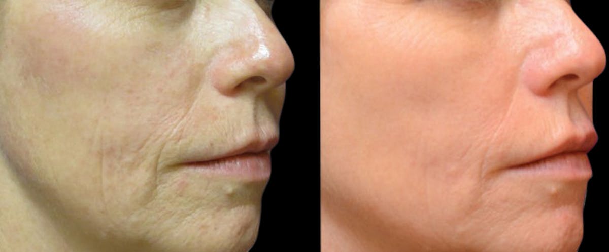 VivaMd Before & After Gallery - Patient 216043 - Image 1