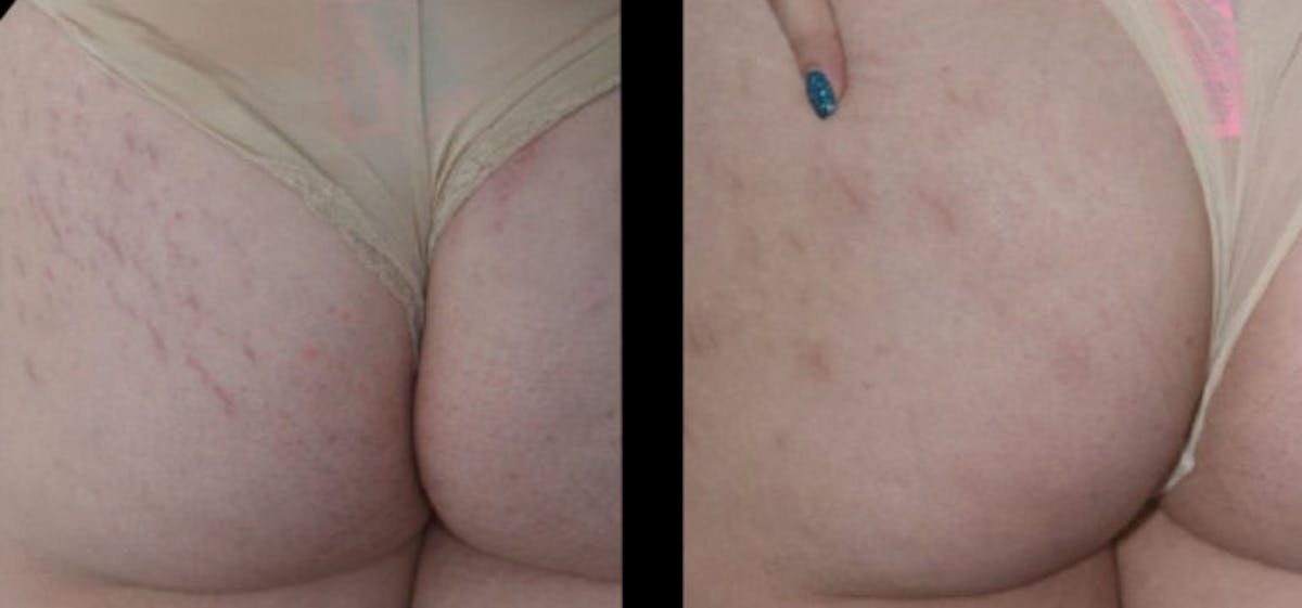 VivaMd Before & After Gallery - Patient 218098 - Image 1