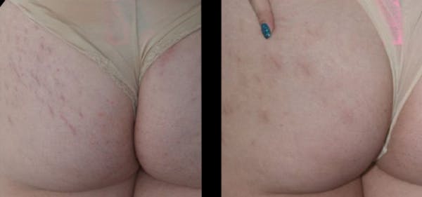 VivaMd Before & After Gallery - Patient 218098 - Image 1