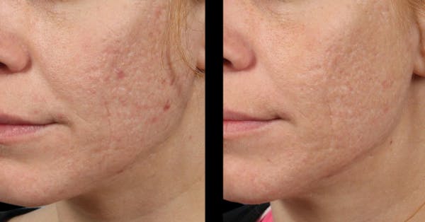 VivaMd Before & After Gallery - Patient 164085 - Image 1