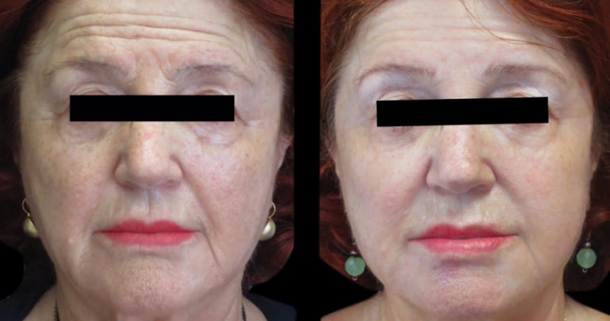 VivaMd Before & After Gallery - Patient 243785 - Image 1