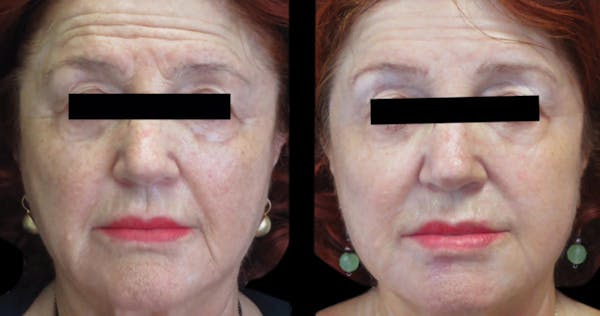 VivaMd Before & After Gallery - Patient 243785 - Image 1