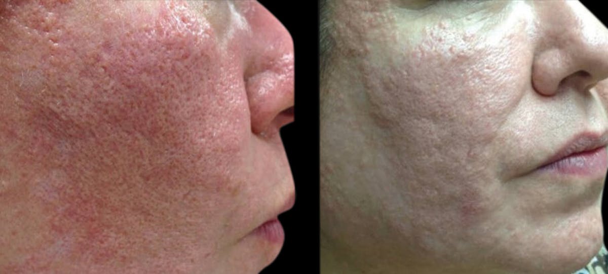 VivaMd Before & After Gallery - Patient 268910 - Image 1