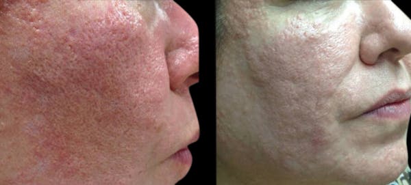 VivaMd Before & After Gallery - Patient 268910 - Image 1