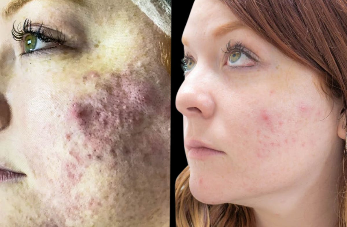 VivaMd Before & After Gallery - Patient 922161 - Image 1