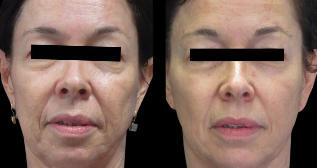 VivaMd Before & After Gallery - Patient 394081 - Image 1