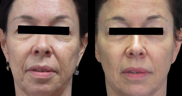 VivaMd Before & After Gallery - Patient 394081 - Image 1