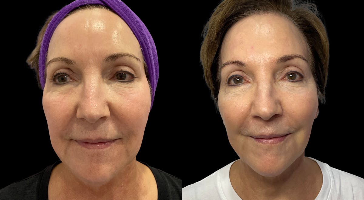 VivaMd Before & After Gallery - Patient 333367 - Image 1