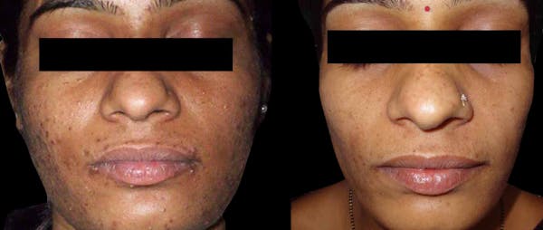VivaMd Before & After Gallery - Patient 523134 - Image 1