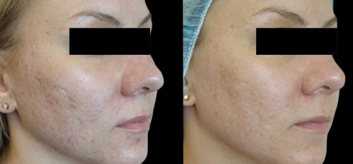 VivaMd Before & After Gallery - Patient 316675 - Image 1