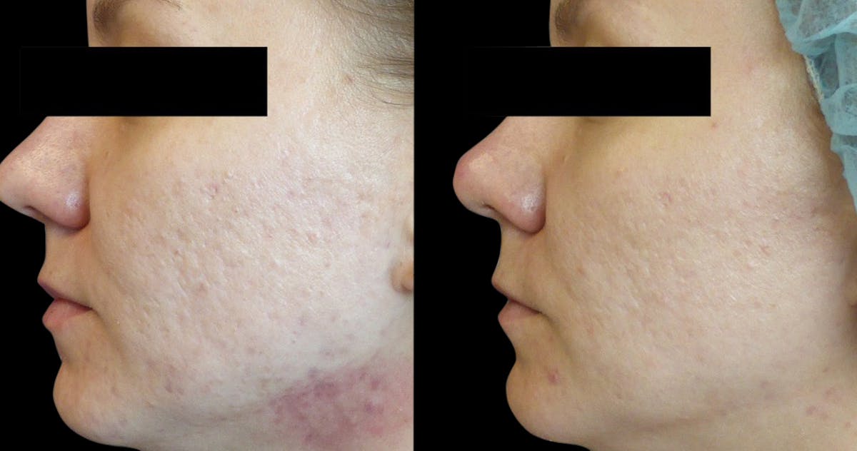 VivaMd Before & After Gallery - Patient 316675 - Image 2