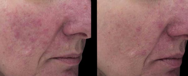 VivaMd Before & After Gallery - Patient 196034 - Image 1