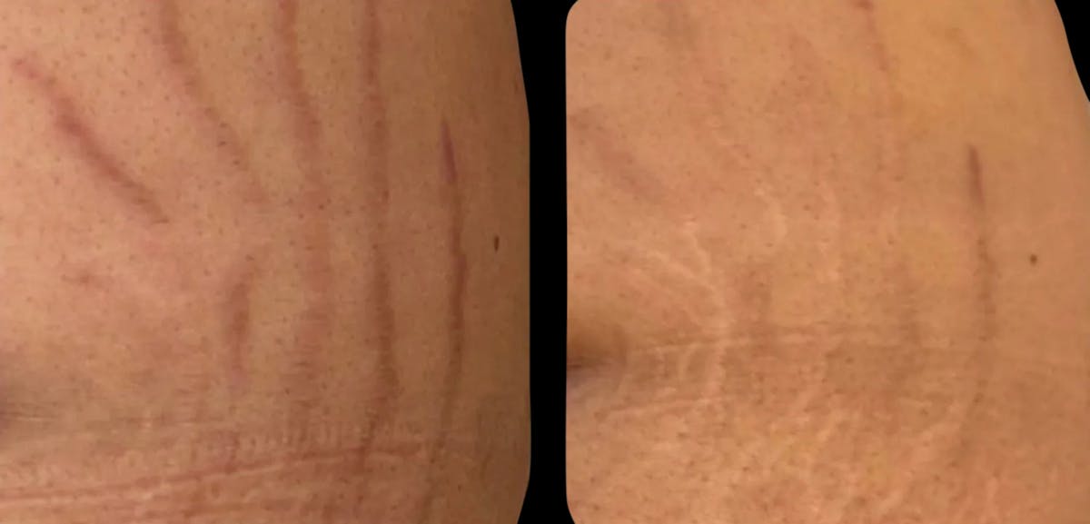 VivaMd Before & After Gallery - Patient 595361 - Image 1