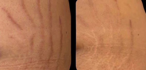 VivaMd Before & After Gallery - Patient 595361 - Image 1
