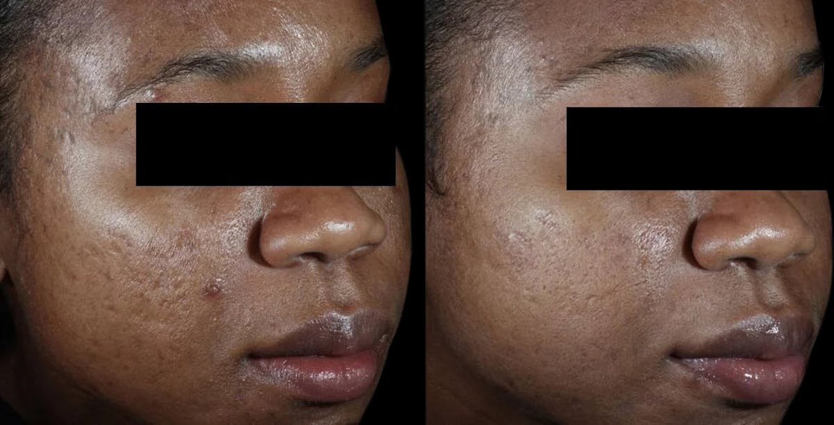 VivaMd Before & After Gallery - Patient 672005 - Image 1