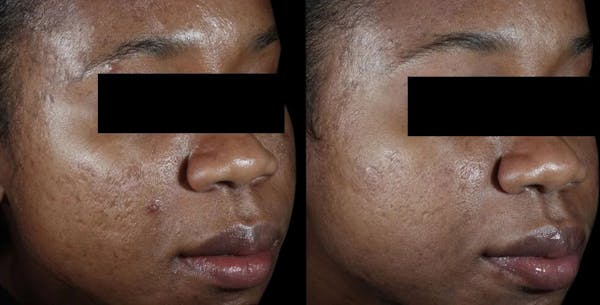 VivaMd Before & After Gallery - Patient 672005 - Image 1