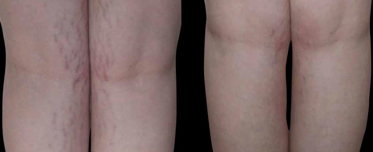 VivaMd Before & After Gallery - Patient 236091 - Image 1