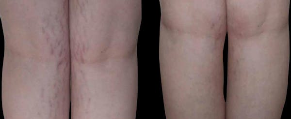 VivaMd Before & After Gallery - Patient 236091 - Image 1