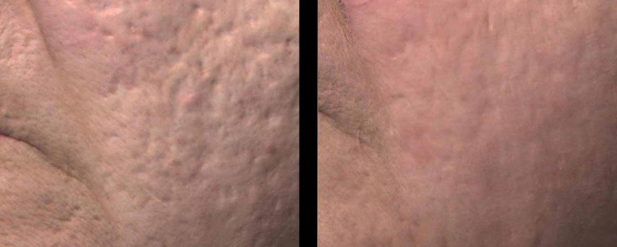 VivaMd Before & After Gallery - Patient 171772 - Image 1