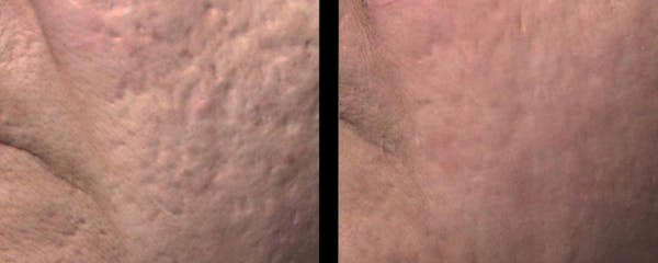 VivaMd Before & After Gallery - Patient 171772 - Image 1