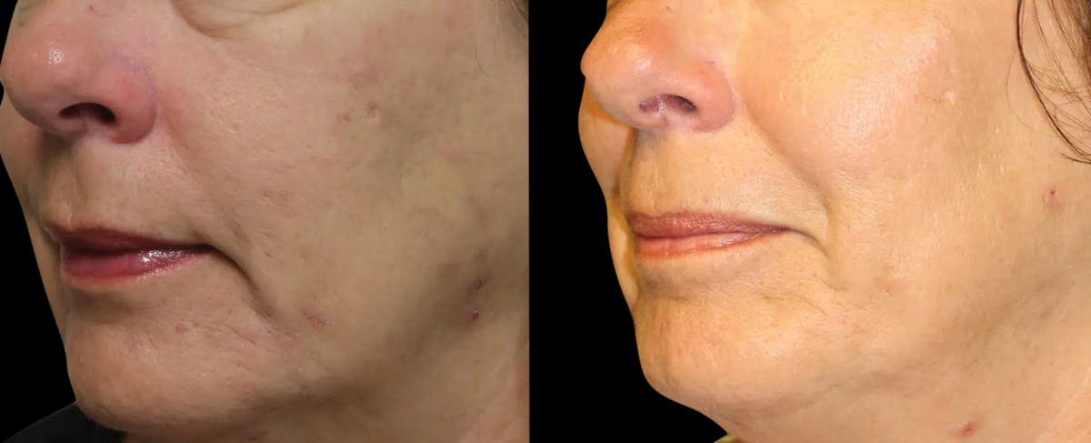 VivaMd Before & After Gallery - Patient 248777 - Image 1