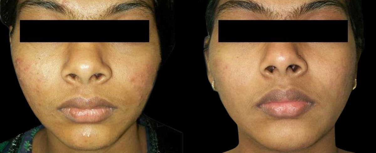 VivaMd Before & After Gallery - Patient 300534 - Image 1