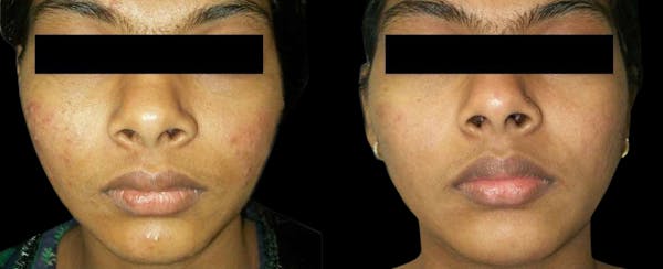 VivaMd Before & After Gallery - Patient 300534 - Image 1