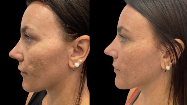VivaMd Before & After Gallery - Patient 420166 - Image 1