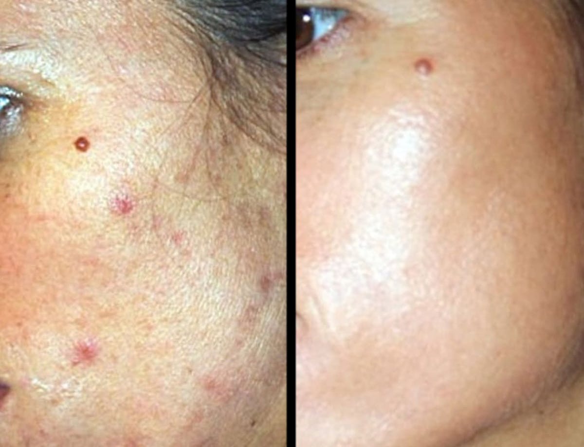 VivaMd Before & After Gallery - Patient 424346 - Image 1